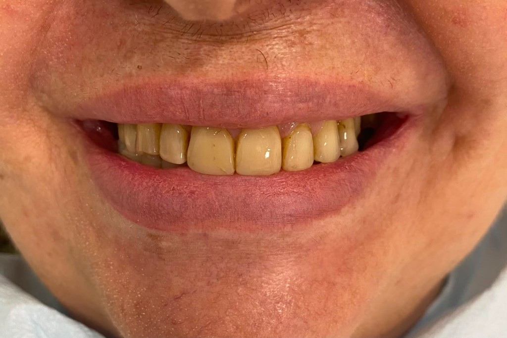 Antes — Facetas