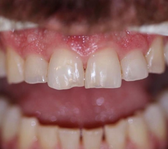 Antes — Restauração estética