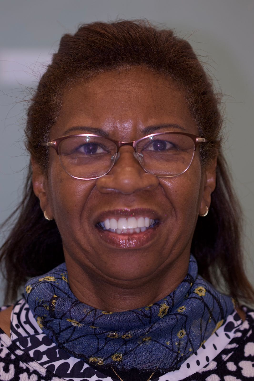 Depois — Facetas e lentes