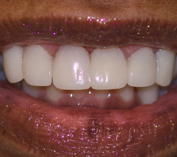 Depois — Facetas e lentes